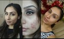 Acne.org does it really work? Is it worth the buy? 4months into using Acne.org results || Raji Osahn