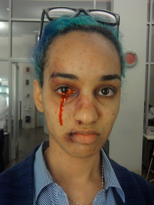 Beat up bloody eye