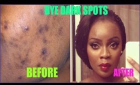 Dark Spots Be Gone | Treating ACNE scars + GIVEAWAY