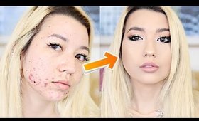 Acne Coverage Foundation Routine | 2018