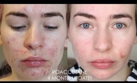 4 MONTH ROACCUTANE UPDATE - Side Effects & My Skin Now