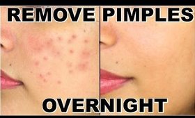 How To Remove Pimples Overnight | Acne Treatment | ShrutiArjunAnand