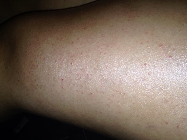 Red bumps on legs? | Beautylish