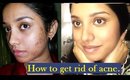 How I got rid of my acne + skin care routine.