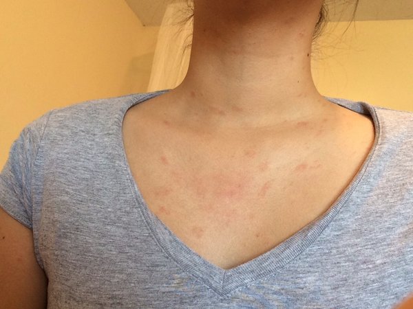 red-spots-on-my-neck