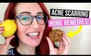 How To Remove Acne Scars NATURALLY At Home! Top 3 Acne Scarring Treatments