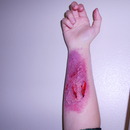 Severe Bruise Practice
