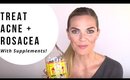 How to Treat Rosacea & Acne With Supplements