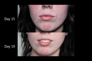 My third week update of using the Clinique Anti Blemish Solutions 3 Step System.
Check out my progress in my videos on my youtube channel: www.youtube.com/chloeluckinphotos