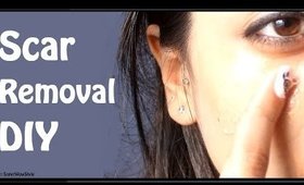Fade Away Acne Scars  - (CLEAR SKIN!) | by SuperWowStyle Prachi