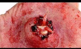 World's Biggest Zit with Maggot Infection!